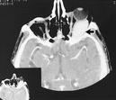 Fig. 3 ­ Aspect tomodensitométrique. Lésion rétrooculaire gauche hyperdense