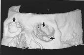 Fig. 4 ­ Reconstruction tridimensionnelle surfacique