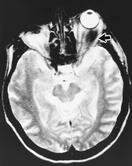 Fig. 6 ­ Séquence IRM pondérée en T2