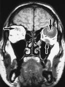 Fig. 8 ­ Coupes coronales. Séquence IRM pondérée en T1 après injection de produit de contraste